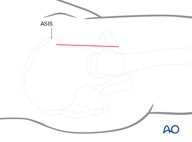 Skin incision for the anterior approach (Smith-Petersen) to the proximal femur