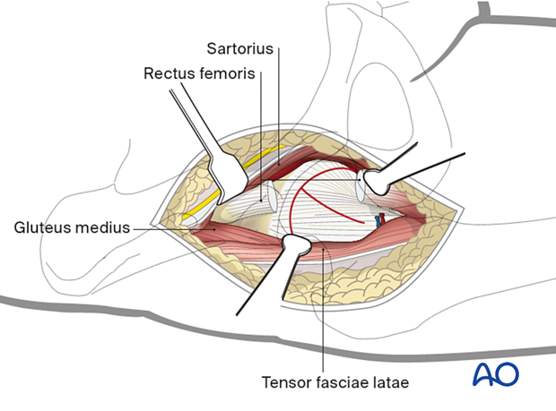 Incision of the hip joint capsule in a T-shaped fashion during the anterior approach (Smith-Petersen) to the proximal femur