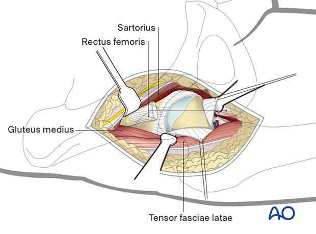 Incision of the hip joint capsule in a T-shaped fashion during the anterior approach (Smith-Petersen) to the proximal femur