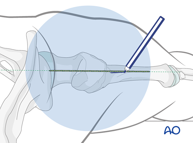 Marking the lateral skin incision with the aid of a K-wire placed on the skin and aligned to the femoral shaft in an axial image intensifier view