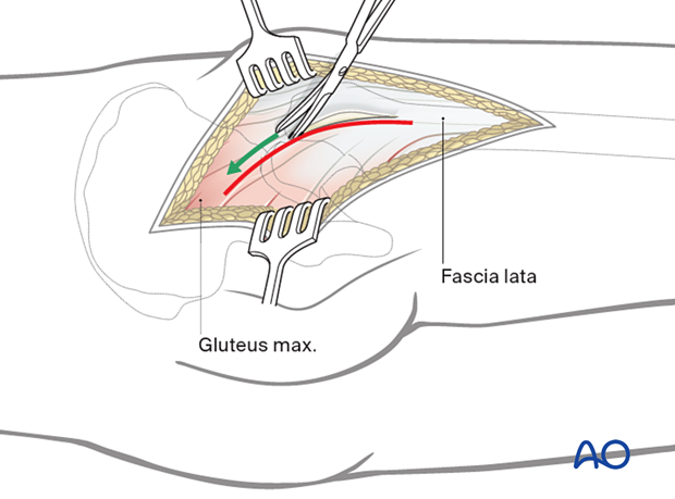 Sharp dissection of the fascia lata and gluteal muscle at the greater trochanter over the trochanteric bursa during the posterolateral (posterior) approach to the hip