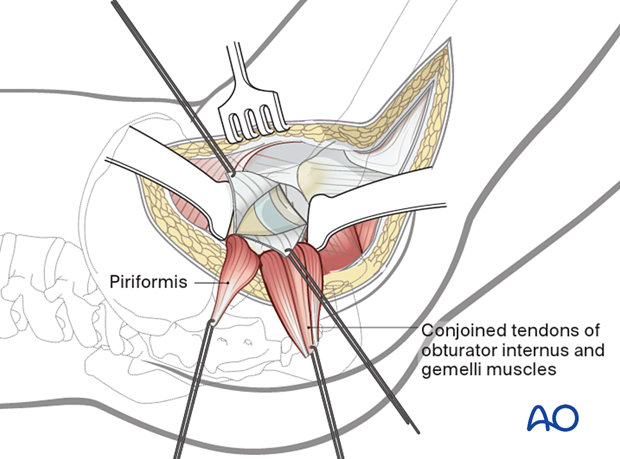 Exposure of the hip joint by creating and reflecting a full-thickness, broad-based flap of the posterior hip capsule during the posterolateral (posterior) approach to the hip