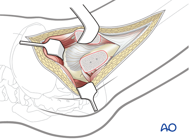 Mobilization of the proximal portion of the vastus intermedius to expose the anterior capsule after trochanteric osteotomy