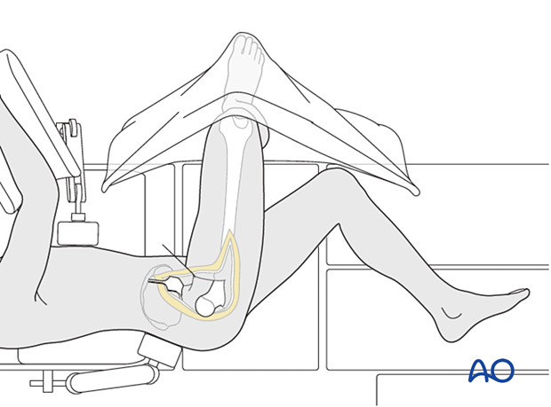 Surgical dislocation of the hip joint by gentle external rotation of the leg