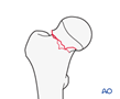 Simple transcervical femoral neck fracture