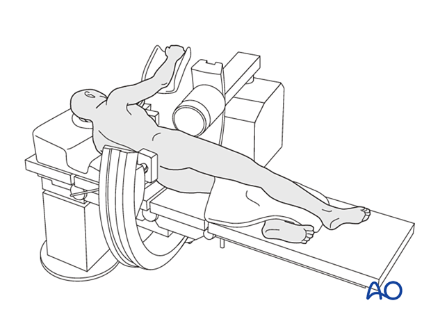 Patient in a lateral decubitus position with the C-arm positioned for AP view of the proximal femur