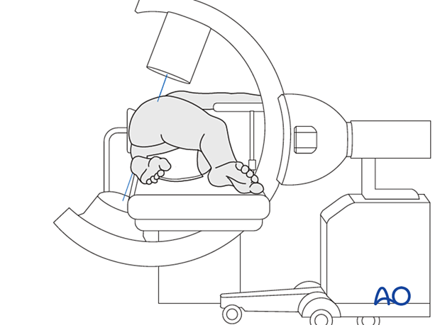 Patient in a lateral decubitus position with the C-arm positioned for lateral view of the proximal femur