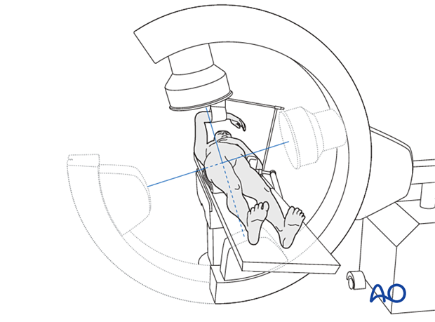 Supine patient position on a radiolucent table with the C-arm positioned for a lateral view of the proximal femur