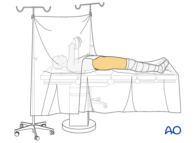 Skin disinfection and free draping of a patient position on a radiolucent table for surgical treatment of proximal femoral fractures