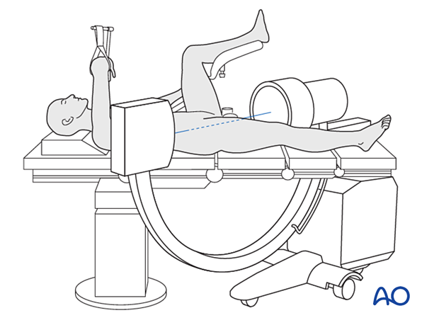 Patient and C-arm position to obtain a lateral view of the proximal femur