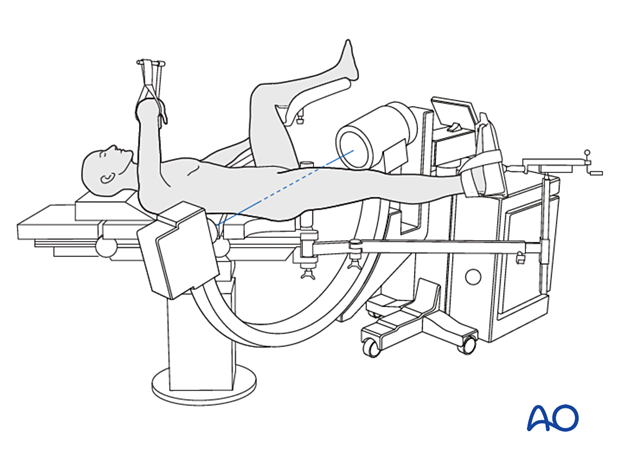 Patient and C-arm position to obtain an axial view of the proximal femur