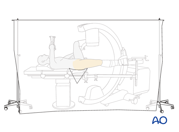 Vertical isolation draping of a patient position on a fracture table with the contralateral leg in a leg holder for surgical treatment of proximal femoral fractures