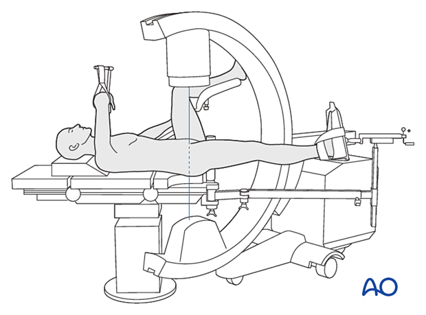 Patient and C-arm position to obtain an AP view of the proximal femur