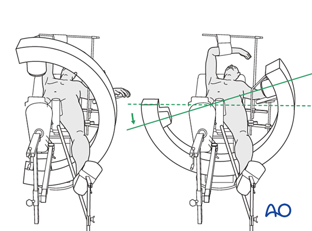 Supine patient position on a fracture table with the legs in scissors position and the C-arm positioned for AP and axial views of the proximal femur