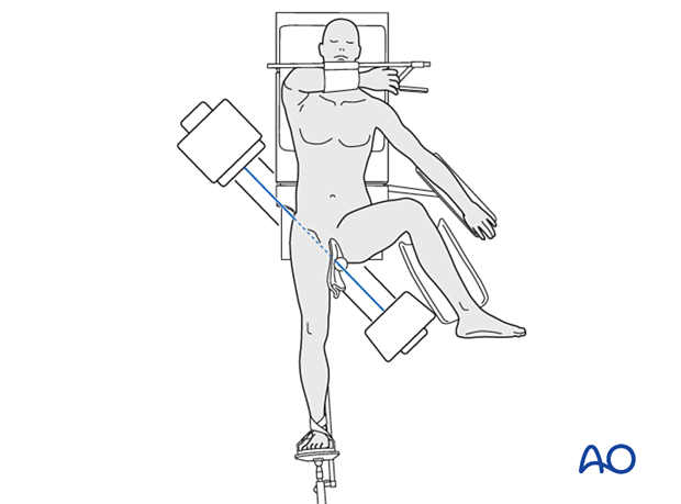 Patient and C-arm position to obtain an axial or lateral view of the proximal femur