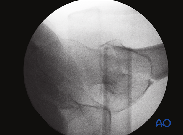 AP view of the proximal femur