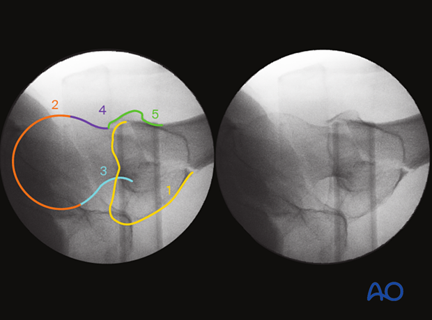 Anatomical landmarks and radiological lines in the lateral view of the proximal femur