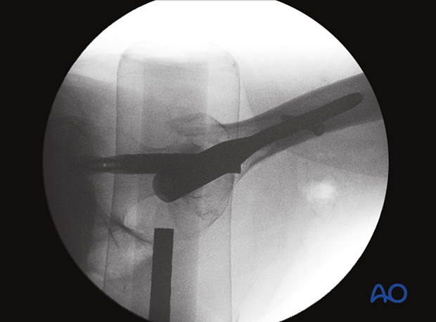 Lateral view of the proximal femur with an intramedullary nail