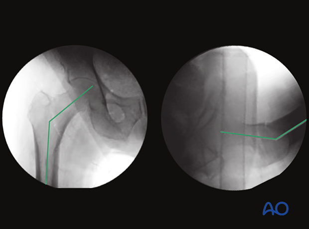 AP and lateral views showing the neck-shaft angle and the anteversion