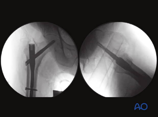 AP and axial views to confirm center-center position of the blade in the femoral head-neck axis after nail fixation