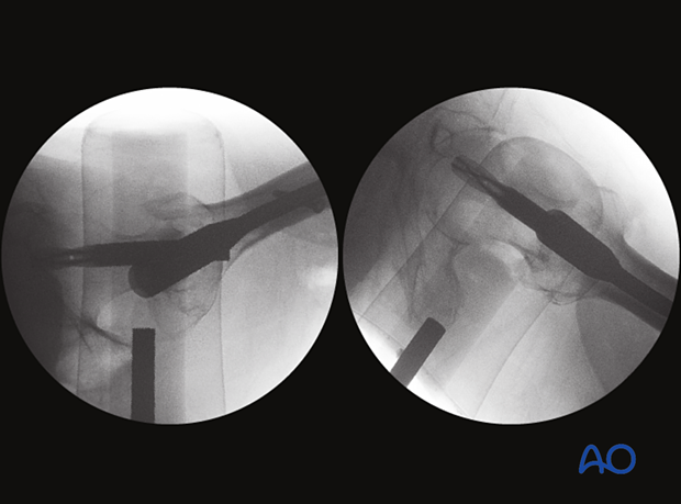 Lateral and axial view of a pertrochanteric fracture stabilized with an intramedullary nail