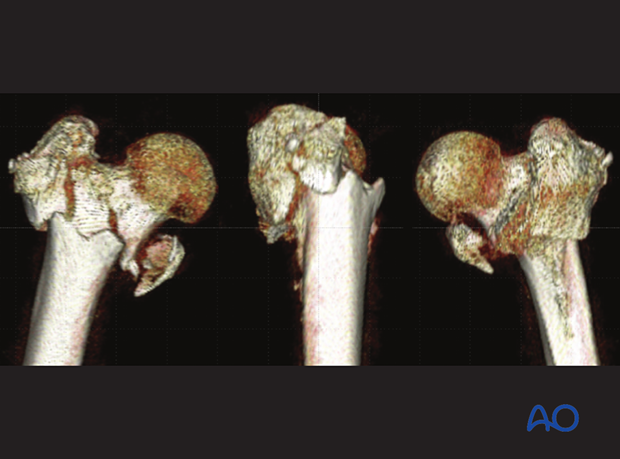 3-D CT image of a complex trochanteric fracture