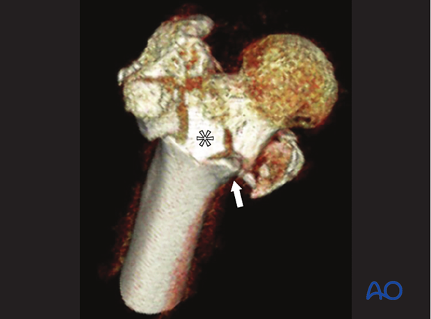 Anterior 3-D CT view of a complex trochanteric fracture with an anterior fragment (asterisk) and a limited cotrical contact (arrow)