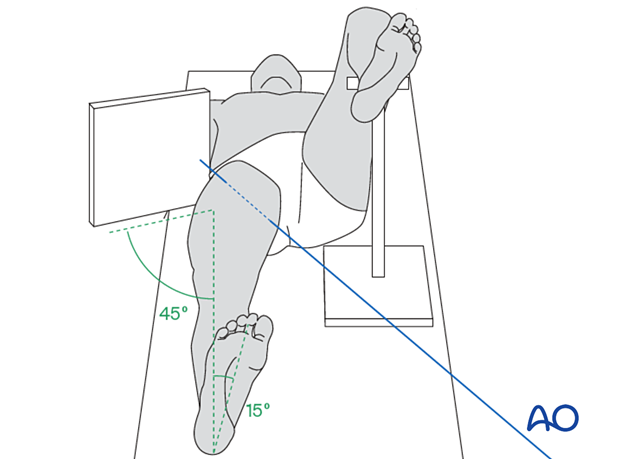 A lateral x-ray of a proximal femoral fracture may be taken with a cross-table view