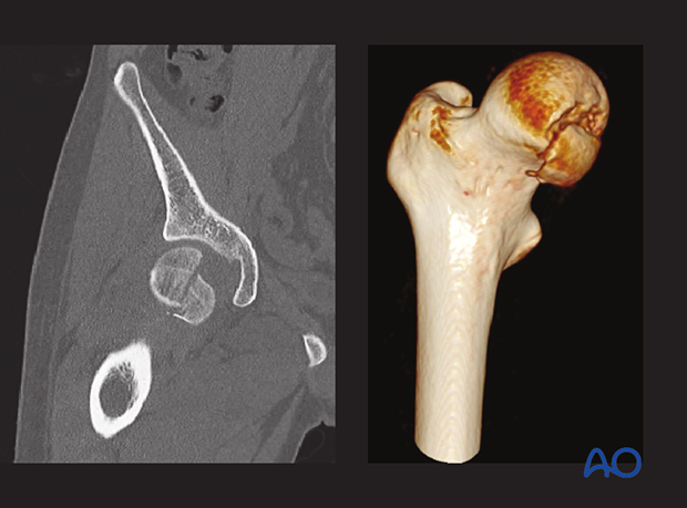 CT images of a split fracture of the femoral head