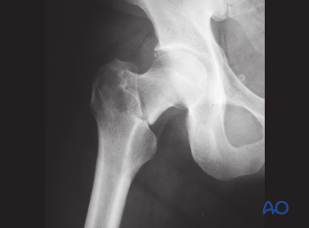 AP x-ray of a basicervical femoral neck fracture