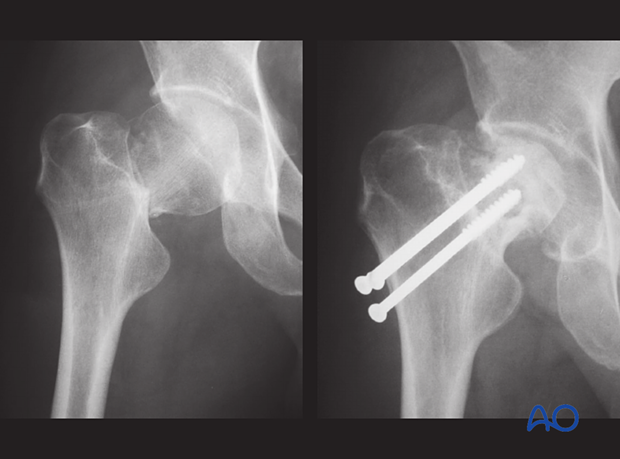 Preoperative x-ray of a transcervical femoral neck fracture; follow-up x-ray with screw stabilization showing avascular necrosis with subchondral collapse