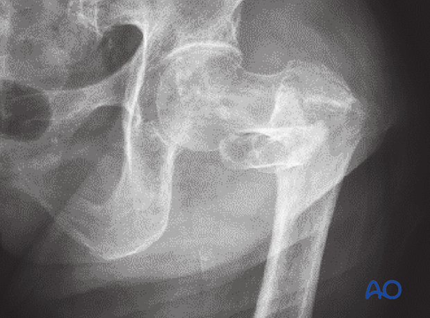 X-ray of a trochanteric fracture with severe varus deformity