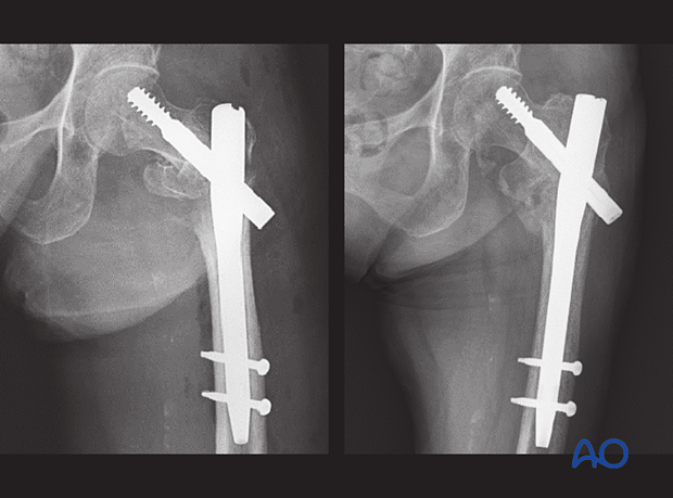 Postoperative x-ray of a trochanteric fracture treated with a short nail without correction of varus deformity