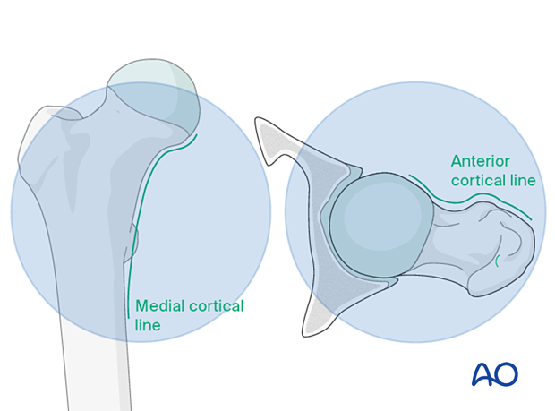 Patterns in AP and lateral view for acceptable reduction of pertrochanteric fractures