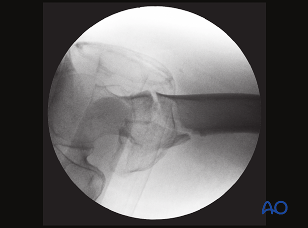 Axial view of a trochanteric fracture showing an opening of the anterior cortical line with slight anterior angulation