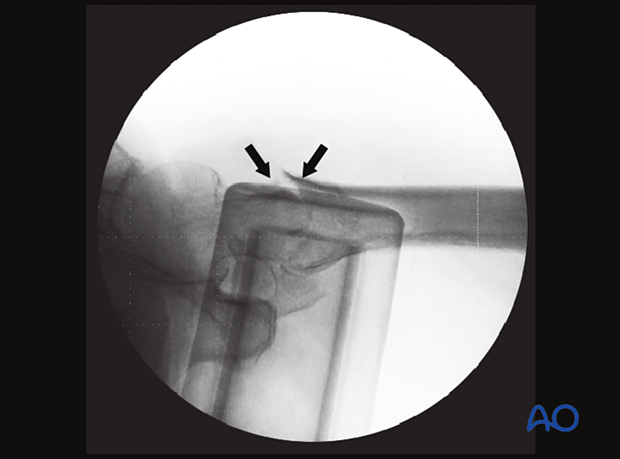 In this trochanteric fracture, the medial cortical line shows a step-off, which needs to be reduced because it tends to slide excessively (into the medullary canal).