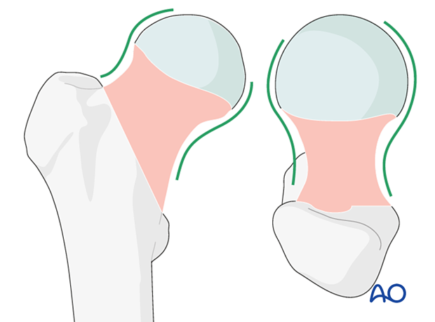 Patterns in AP and lateral views for acceptable reduction of femoral neck fractures show intact Lowell’s S-patterns (“lazy S”).