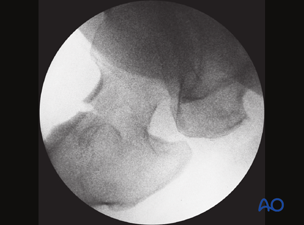 Axial view of a femoral neck fracture showing retroversion with a gap in the anterior cortex