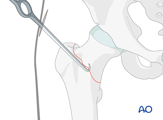 Hook leverage technique for a reduction of a step-off or neck-down deformity of a trochanteric fracture