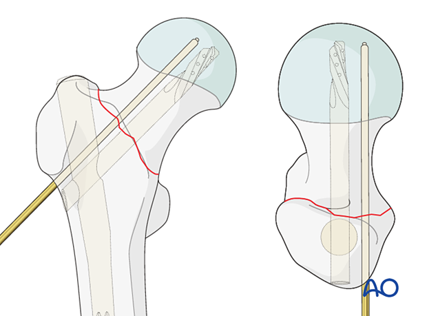 Insertion of a K-wire for preliminary stabilization of the reduced trochanteric fracture with a planned nail fixation