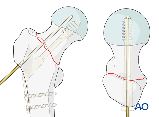 Insertion of a K-wire for preliminary stabilization of the reduced trochanteric fracture with a planned sliding hip screw fixation