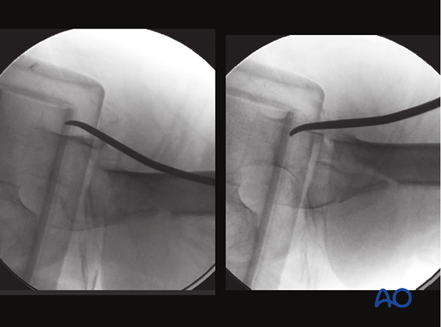 Axial view of a trochanteric fracture with the anterior beak of the proximal fragment reduced with an elevator