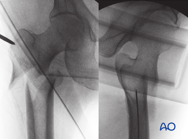 Intraoperative views of an intertrochanteric fracture 