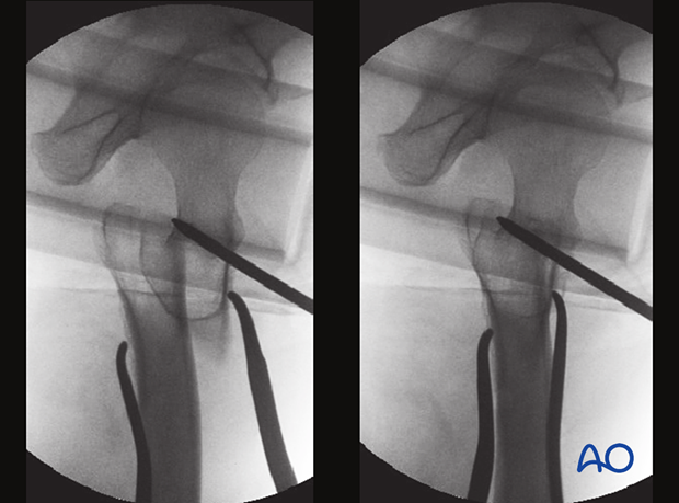 Lateral views of an intertrochanteric fracture reduction with a trochanteric joystick and two Hohmann retractors