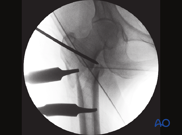 AP view of an intertrochanteric fracture reduction with a trochanteric joystick and two Hohmann retractors