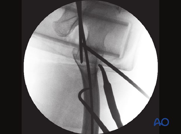 Lateral view of an intertrochanteric fracture reduction with a trochanteric joystick, a Hohmann retractor, and a bone hook