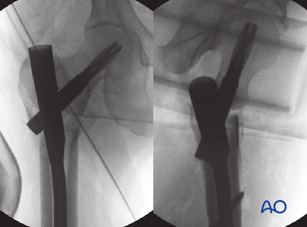 AP and lateral view of an intertrochanteric fracture fixed with a short nail