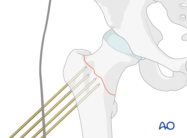 -400147155-79976345K-wires ready for preliminary stabilization of a reduced femoral neck fracture