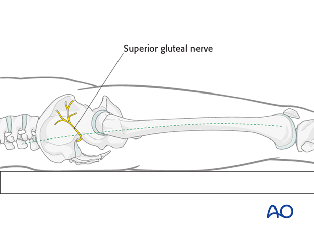 antegrade nailing approach with piriformis entry point