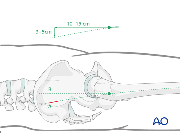 antegrade nailing approach with piriformis entry point